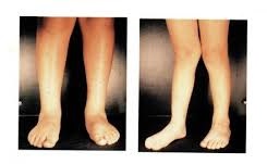 Dépistage des troubles orthopédique du nourrisson, de l'enfant et de l'adolescent