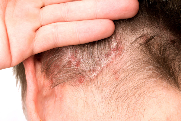 Psoriasis, psoriatic skin disease